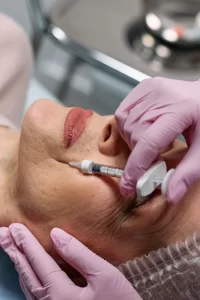 Foto de senhora no procedimento de preenchimento facial em curitiba